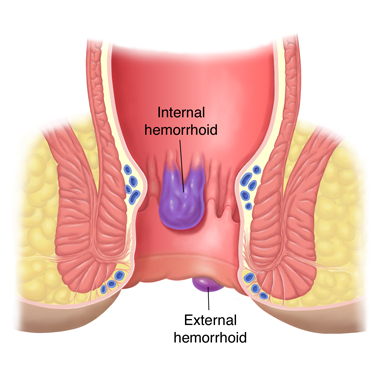 Hemorrhoids Piles